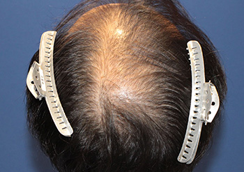 40代 男性 M.H.さん 前頭部・頭頂部 自毛植毛（MIRAI法） 3,000株の症例（施術前）_頭頂部