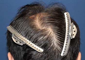 40代 男性 M.H.さん 前頭部・頭頂部 自毛植毛（MIRAI法） 3,000株の症例（施術後）_頭頂部