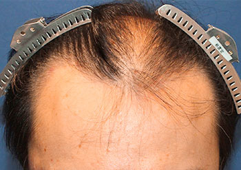 40代 男性 M.H.さん  前頭部・頭頂部 自毛植毛（MIRAI法） 3,000株の症例（施術前）