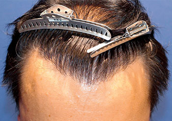 40代 男性 M.H.さん  前頭部・頭頂部 自毛植毛（MIRAI法） 3,000株の症例（施術後）