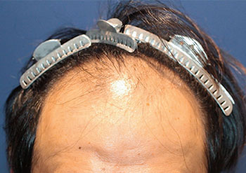 30代 男性 T.M.さん  頭頂部 自毛植毛（MIRAI法） 2,000株の症例（施術前）