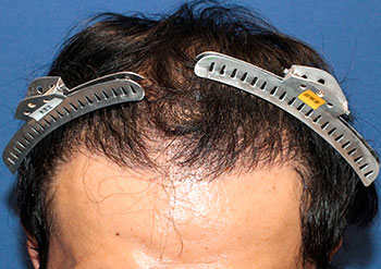 30代 男性 T.M.さん  頭頂部 自毛植毛（MIRAI法） 2,000株の症例（施術後）