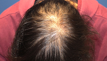 20代 男性 O.R.さん  頭頂部 自毛植毛（MIRAI法） 1,351株の症例（施術前）