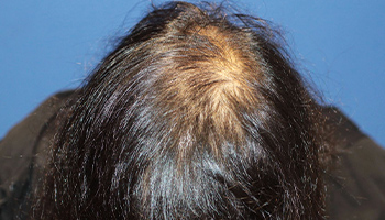 20代 男性 O.R.さん  頭頂部 自毛植毛（MIRAI法） 1,351株の症例（施術後）