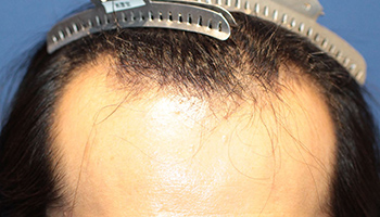 20代 男性 G.S.さん  生え際 自毛植毛（MIRAI法） 1,700株の症例（施術前）