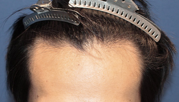 20代 男性 M.S.さん  生え際 自毛植毛（MIRAI法） 1,200株の症例（施術前）