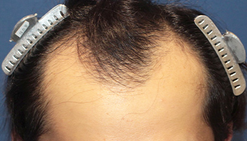 30代 男性 K.Y.さん  生え際・頭頂部 自毛植毛（MIRAI法） 2,000株の症例（施術前）