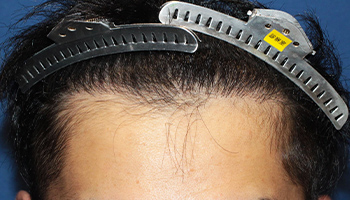 30代 男性 K.Y.さん  生え際・頭頂部 自毛植毛（MIRAI法） 2,000株の症例（施術後）