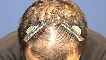 30代 男性 S.T.さん 生え際 前頭部 頭頂部 自毛植毛（MIRAI法） 2,000株（施術前）_頭頂部