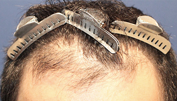 30代 男性 S.T.さん  生え際 前頭部 頭頂部 自毛植毛（MIRAI法） 2,000株（施術前）