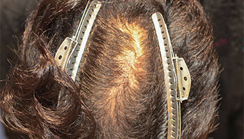 30代 男性 M.K.さん  頭頂部 自毛植毛（MIRAI法） 1,200株の症例（施術前）