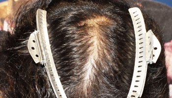 30代 男性 M.K.さん  頭頂部 自毛植毛（MIRAI法） 1,200株の症例（施術後）
