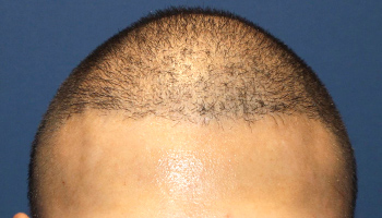 代 男性 A M さん 前頭部 頭頂部 自毛植毛 Mirai法 3 000株 自毛植毛の症例