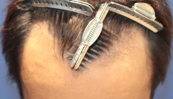 30代 男性 M.S.さん  頭頂部 生え際 自毛植毛（MIRAI法） 1,500株の症例（施術前）