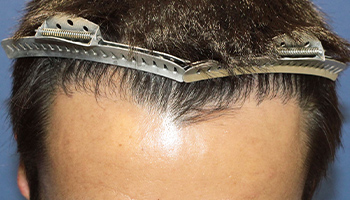30代 男性 M.S.さん  頭頂部 生え際 自毛植毛（MIRAI法） 1,500株の症例（施術後）