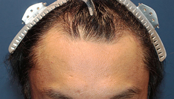 40代 男性 A.S.さん  生え際 頭頂部 自毛植毛（MIRAI法） 2,000株の症例（施術前）