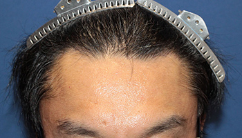 240代 男性 A.S.さん  生え際 頭頂部 自毛植毛（MIRAI法） 2,000株の症例（施術後）