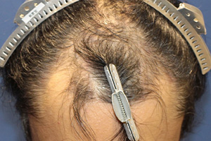 40代 男性 A.S.さん  生え際・前頭部 自毛植毛（MIRAI法） 2,000株の症例（施術前）