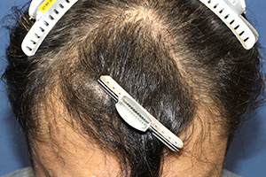 40代 男性 A.S.さん  生え際・前頭部 自毛植毛（MIRAI法） 2,000株の症例（施術後）