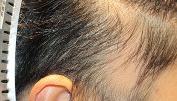 20代 男性 T.T.さん  生え際 こめかみ 自毛植毛（MIRAI法） 800株の症例（施術前）