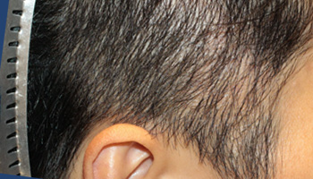 20代 男性 T.T.さん  生え際 こめかみ 自毛植毛（MIRAI法） 800株の症例（施術後）