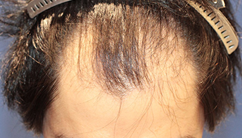 30代 男性 Y.T.さん  生え際・前頭部 自毛植毛（MIRAI法） 2,500株の症例（施術前）