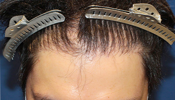 30代 男性 Y.T.さん  生え際・前頭部 自毛植毛（MIRAI法） 2,500株の症例（施術後）