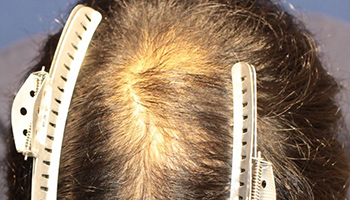 20代 男性 T.M.さん  生え際・前頭部 自毛植毛（MIRAI法） 1,500株の症例（施術前）