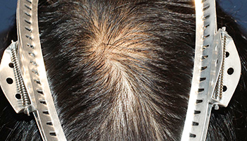 20代 男性 T.M.さん  生え際・前頭部 自毛植毛（MIRAI法） 1,500株の症例（施術後）