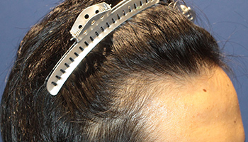 20代 男性 M.T.さん  生え際 自毛植毛（MIRAI法） 1,300株の症例（施術前）