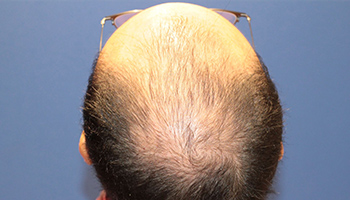 30代 男性 O.H.さん  前頭部・頭頂部 自毛植毛（MIRAI法） 3,000株の症例（施術前）