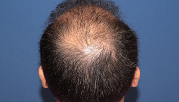 30代 男性 O.H.さん  前頭部・頭頂部 自毛植毛（MIRAI法） 3,000株の症例（施術後）