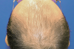 30代 男性 O.H.さん  生え際・前頭部・頭頂部 自毛植毛（MIRAI法） 3,000株の症例（施術前）
