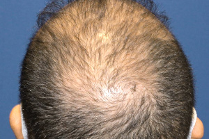 30代 男性 O.H.さん  生え際・前頭部・頭頂部 自毛植毛（MIRAI法） 3,000株の症例（施術後）
