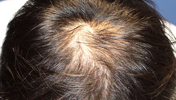 30代 男性 N.T.さん  生え際・頭頂部 自毛植毛（MIRAI法） 1,500株の症例（施術前）