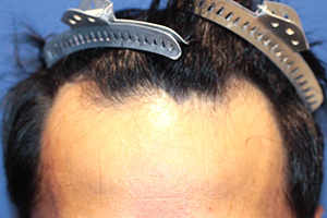 50代 男性 F.A.さん  生え際 前頭部 自毛植毛（MIRAI法） 1,800株の症例（施術前）
