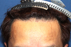 50代 男性 F.A.さん  生え際 前頭部 自毛植毛（MIRAI法） 1,800株の症例（施術後）