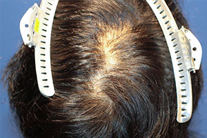 20代 男性 I.R.さん 頭頂部 つむじ 自毛植毛（MIRAI法） 800株の症例（施術前）