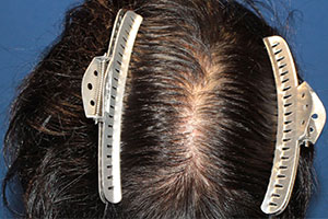 20代 男性 I.R.さん 頭頂部 つむじ 自毛植毛（MIRAI法） 800株の症例（施術後）