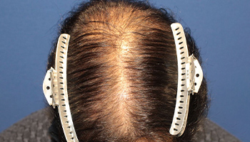 50代 男性 T.R.さん  前頭部 頭頂部 自毛植毛（MIRAI法） 1,000株の症例（施術前）