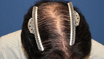 50代 男性 T.R.さん  前頭部 頭頂部 自毛植毛（MIRAI法） 1,000株の症例（施術後）