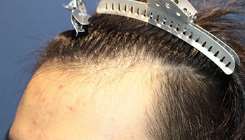 20代 男性 K.W.さん  生え際 自毛植毛（MIRAI法） 600株の症例（施術前）