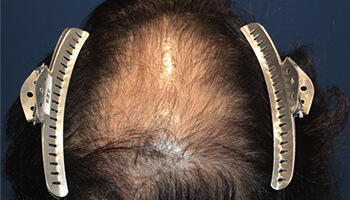 20代 男性 N.R.さん 前頭部・頭頂部 自毛植毛（MIRAI法） 2,000株の症例（手術前）_01