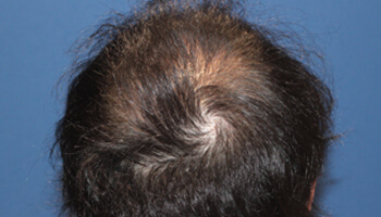 20代 男性 N.R.さん 前頭部・頭頂部 自毛植毛（MIRAI法） 2,000株の症例（手術後）_01
