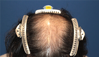 20代 男性 N.R.さん 前頭部・頭頂部 自毛植毛（MIRAI法） 2,000株の症例（手術前）_02