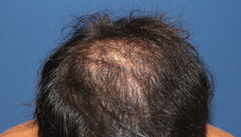 20代 男性 N.R.さん 前頭部・頭頂部 自毛植毛（MIRAI法） 2,000株の症例（手術後）_02