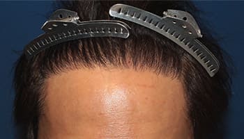 40代 男性 A.J.さん 生え際 前頭部 自毛植毛（MIRAI法） 2,000株の症例（手術後）_02