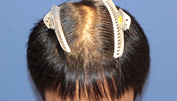 30代 男性 H.Y.さん 頭頂部 自毛植毛（MIRAI法） 1,000株の症例（手術前）_01