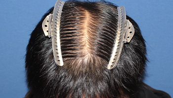 30代 男性 H.Y.さん 頭頂部 自毛植毛（MIRAI法） 1,000株の症例（手術後）_01