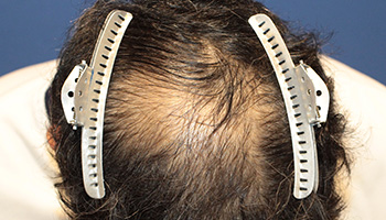 頭頂部の自毛植毛症例写真 50代男性 2,500株 治療前